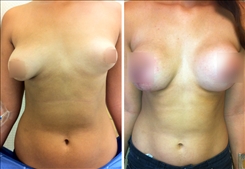 Breast Augmentation Patient Before & After Photo 1