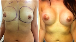 Breast Augmentation Patient Before & After Photo 1