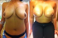Breast Procedures Patient Before & After Photo 1