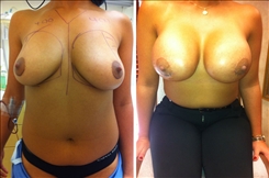 Breast Augmentation Patient Before & After Photo 1