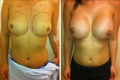 Breast Augmentation Patient Before & After Photo 1