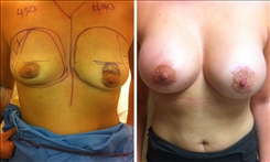 Breast Augmentation Patient Before & After Photo 1