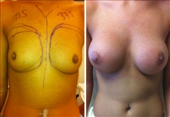 Breast Augmentation Patient Before & After Photo 1