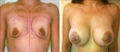Breast Procedures Patient Before & After Photo 1