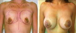 Breast Augmentation Patient Before & After Photo 1