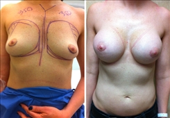 Breast Augmentation Patient Before & After Photo 1