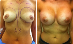 Breast Augmentation Patient Before & After Photo 1