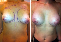 Breast Augmentation Patient Before & After Photo 1