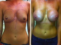 Breast Augmentation Patient Before & After Photo 1