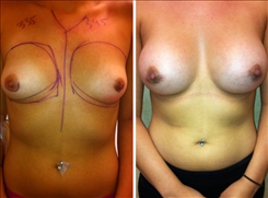 Breast Augmentation Patient Before & After Photo 1