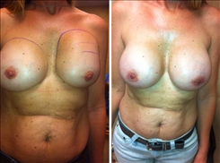 Breast Augmentation Patient Before & After Photo 1