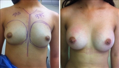 Breast Augmentation Patient Before & After Photo 1