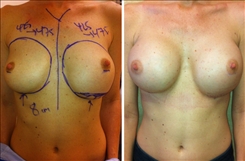 Breast Procedures Patient Before & After Photo 1