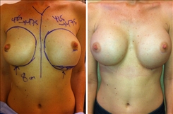 Breast Augmentation Patient Before & After Photo 1