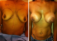 Breast Augmentation Patient Before & After Photo 1