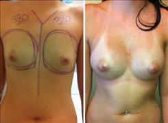 Breast Augmentation Patient Before & After Photo 1