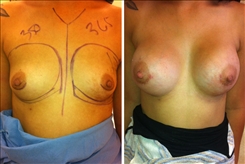 Breast Augmentation Patient Before & After Photo 1