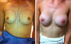 Breast Augmentation Patient Before & After Photo 1