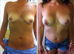 Breast Augmentation Patient Before & After Photo 1