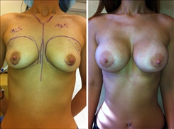 Breast Augmentation Patient Before & After Photo 1