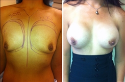 Breast Augmentation Patient Before & After Photo 1