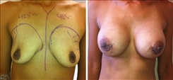 Breast Augmentation Patient Before & After Photo 1