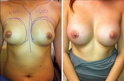 Breast Augmentation Patient Before & After Photo 1