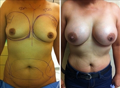 Breast Augmentation Patient Before & After Photo 1