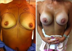 Breast Augmentation Patient Before & After Photo 1