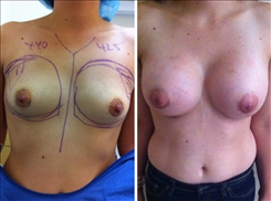 Breast Augmentation Patient Before & After Photo 1