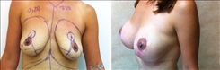 Breast Augmentation Patient Before & After Photo 1