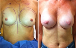 Breast Augmentation Patient Before & After Photo 1