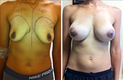 Breast Augmentation Patient Before & After Photo 1