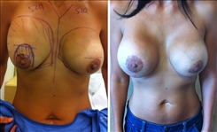 Breast Augmentation Patient Before & After Photo 1