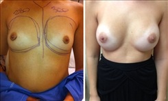 Breast Augmentation Patient Before & After Photo 1