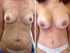 Breast Augmentation Patient Before & After Photo 1