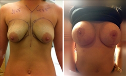 Breast Augmentation Patient Before & After Photo 1