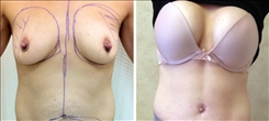 Breast Augmentation Patient Before & After Photo 1