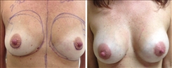 Breast Augmentation Patient Before & After Photo 1