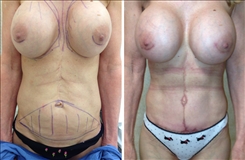 Breast Augmentation Patient Before & After Photo 1