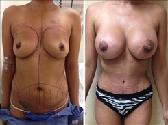 Breast Augmentation Patient Before & After Photo 1