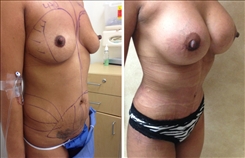 Breast Augmentation Patient Before & After Photo 1