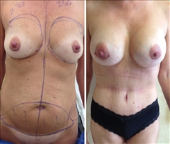 Breast Augmentation Patient Before & After Photo 1