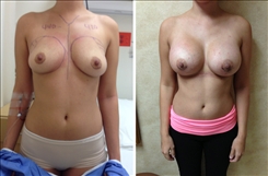 Breast Augmentation Patient Before & After Photo 1