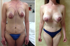 Breast Augmentation Patient Before & After Photo 1