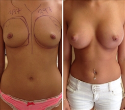 Breast Augmentation Patient Before & After Photo 1