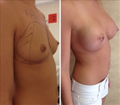 Breast Augmentation Patient Before & After Photo 1