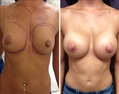 Breast Augmentation Patient Before & After Photo 1