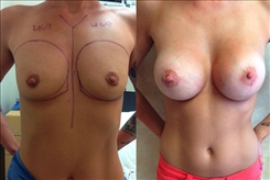 Breast Augmentation Patient Before & After Photo 1