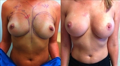 Breast Augmentation Patient Before & After Photo 1